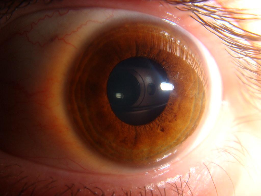 Контактные линзы — сферические и асферические. В чем отличия