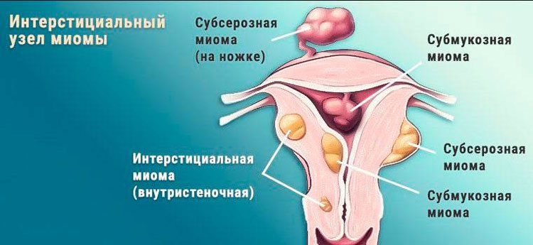 Интерстициальный узел миомы матки —  симптомы, диагностика и лечение
